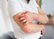 Lawan Infeksi Jamur Kulit dengan 5 Cara Alami yang Ampuh dan Mudah Dilakukan