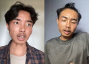 Pria Ini Idap Penyakit Kulit Akibat Pakai Baju Thrifting Tanpa Dicuci, Kenali Gejalanya