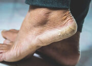 Waspada! 5 Gejala di Kaki Ini Bisa Jadi Tanda Awal Penyakit Serius